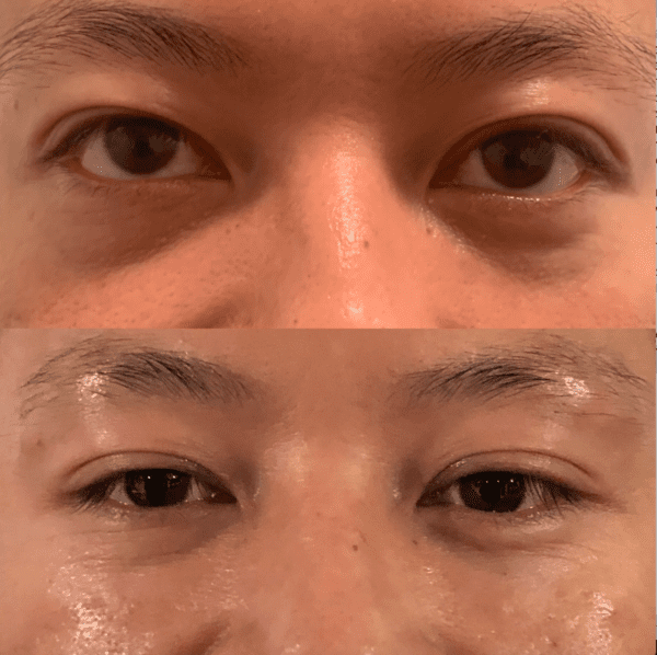 Before & After Image | KOCO Medical Aesthetics | Woodinville, WA
