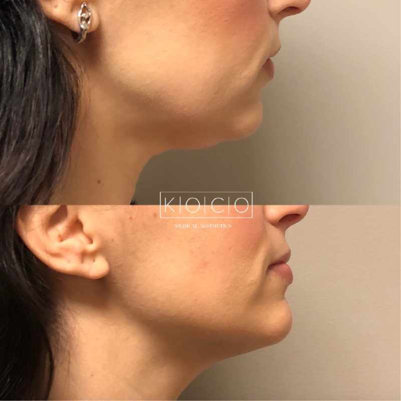 chin and jawline augmentation