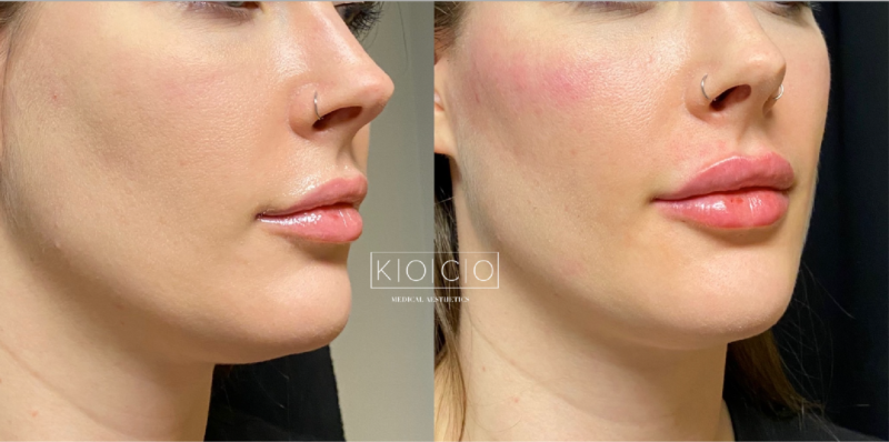 signature cheek and lip augmentation3