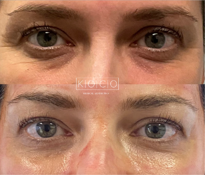 tear trough under eyes augmentation2