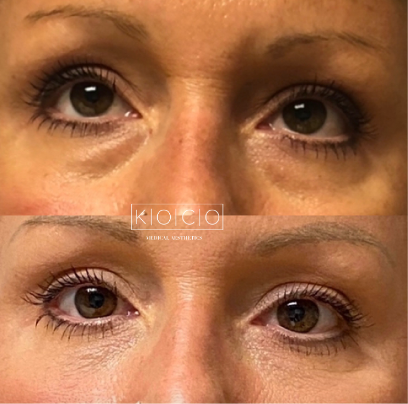 tear trough under eyes augmentation3