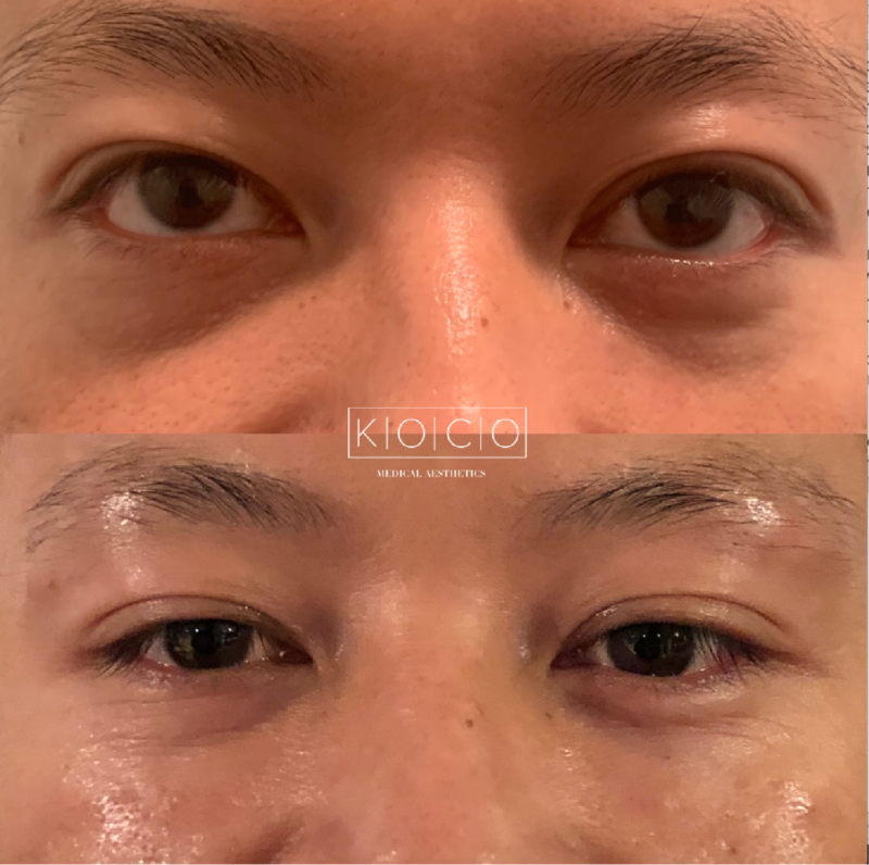 tear trough under eyes augmentation5