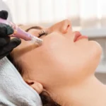 Mesotherapy Treatment in Woodinville WA by KOCO Medical Aesthetics