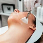 Professional chemical peel application for skin resurfacing at KOCO Medical Aesthetics.