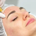 Women receiving PRP/PRF in Woodinville, WA