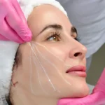 PDO Thread Lift procedure being performed on a patient in Woodinville, WA