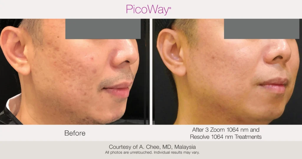 KOCO Acne Scar & Texture Restore™ 1 Acne Scar & Texture