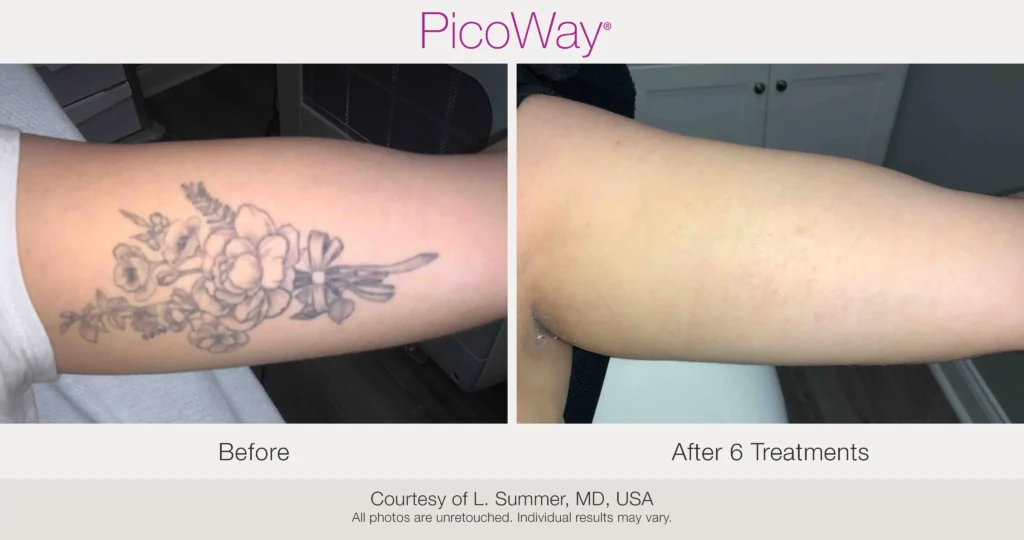 Advanced Tattoo Removal 2 Advanced Tattoo Removal 1