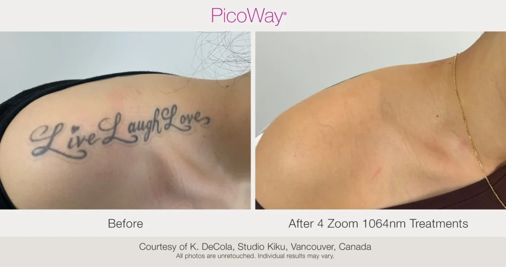 Advanced Tattoo Removal 3 Advanced Tattoo Removal 2