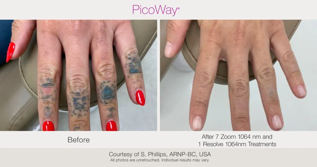 Advanced Tattoo Removal 4 Advanced Tattoo Removal 3