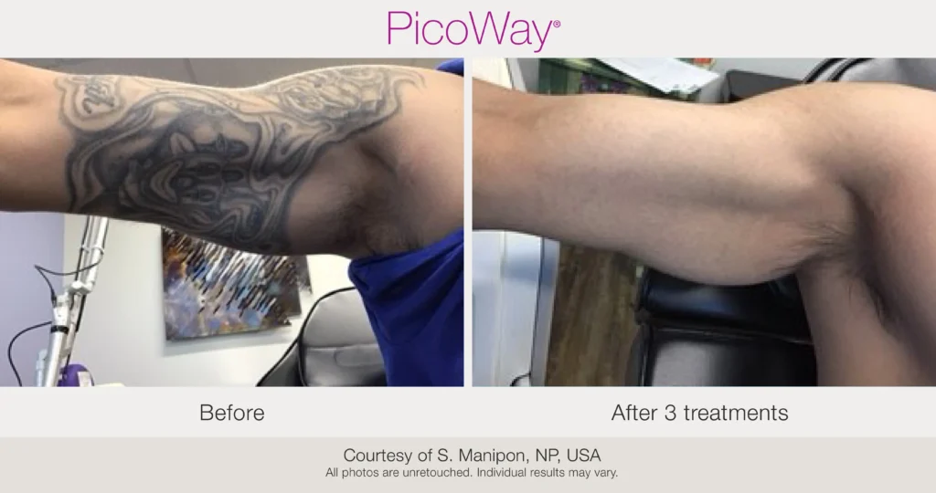 Advanced Tattoo Removal 1 dvanced Tattoo Removal