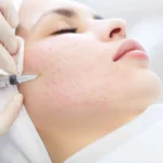 Mesotherapy