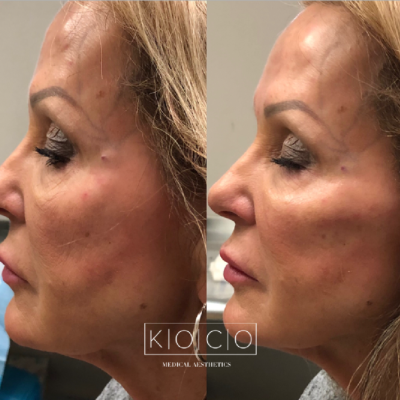 Home 3 Before & After Image | KOCO Medical Aesthetics | Woodinville, WA