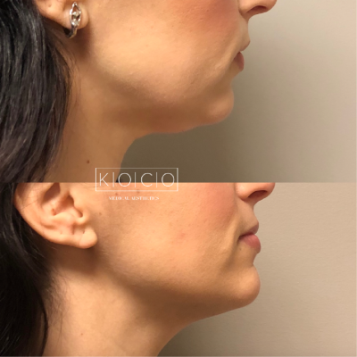 Home 5 Before & After Image | KOCO Medical Aesthetics | Woodinville, WA