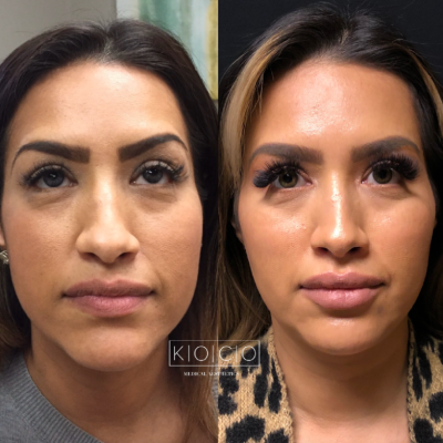 Home 7 Before & After Image | KOCO Medical Aesthetics | Woodinville, WA