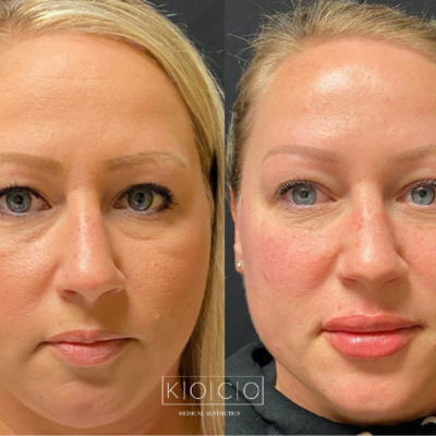 Home 2 Before & After Image | KOCO Medical Aesthetics | Woodinville, WA