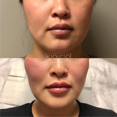 Home 6 Before & After Image | KOCO Medical Aesthetics | Woodinville, WA