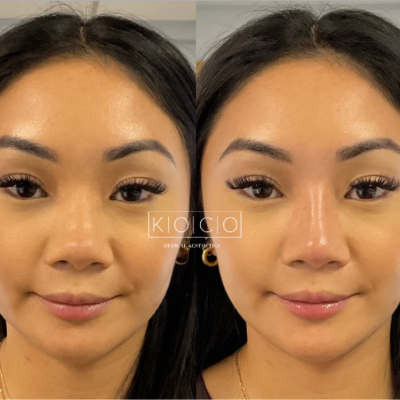Home 1 Before & After Image | KOCO Medical Aesthetics | Woodinville, WA