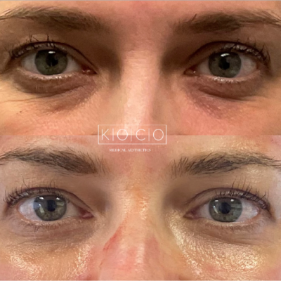 Home 4 Before & After Image | KOCO Medical Aesthetics | Woodinville, WA